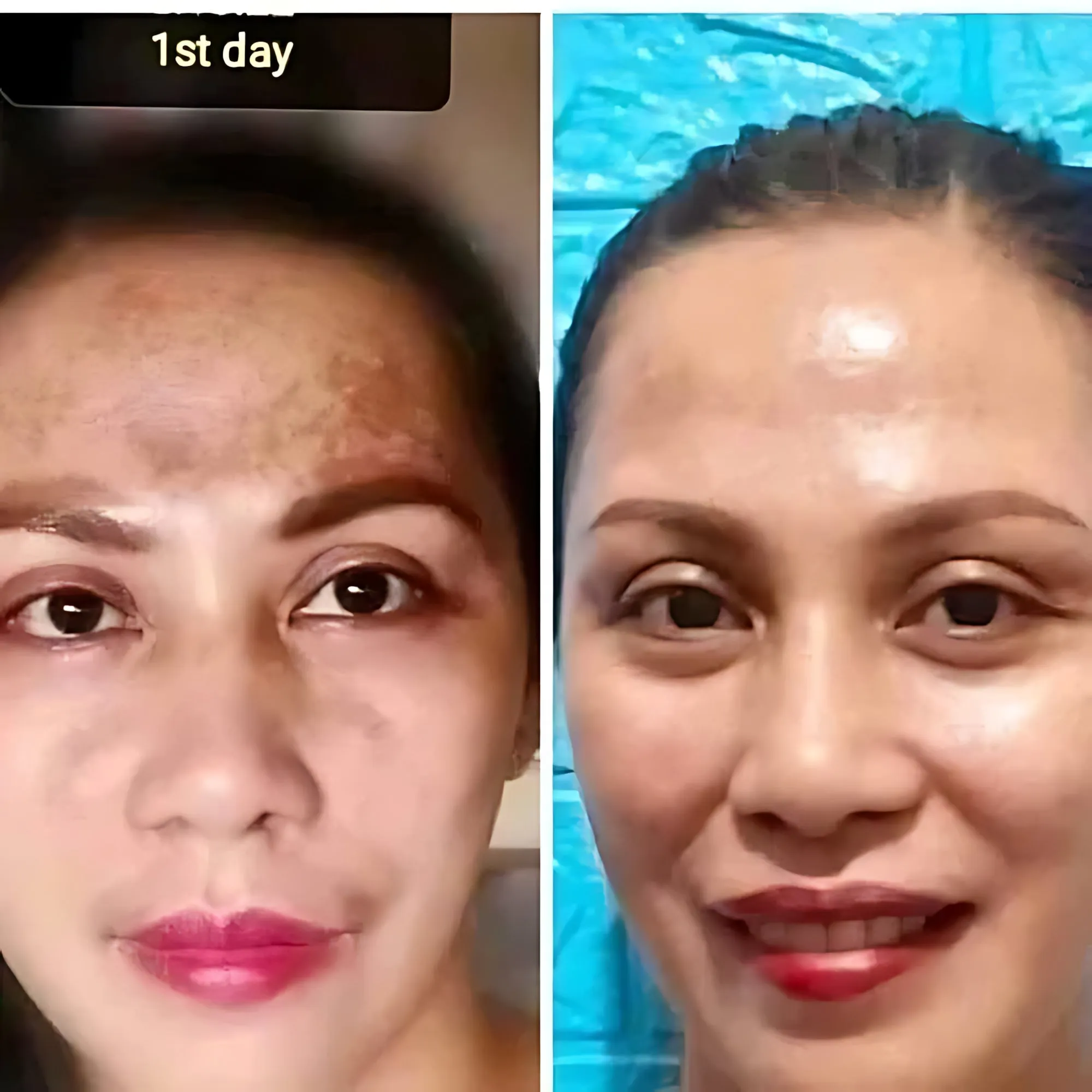 Her Choice Ph Pekas Remover Cream - 50g Her Choice Ph Pekas Remover Cream - 50g