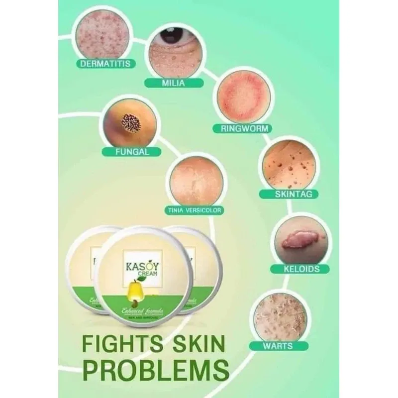 Kasoy Cream Warts Remover Angel Touch - 5g Kasoy Cream Warts Remover Angel Touch - 5g