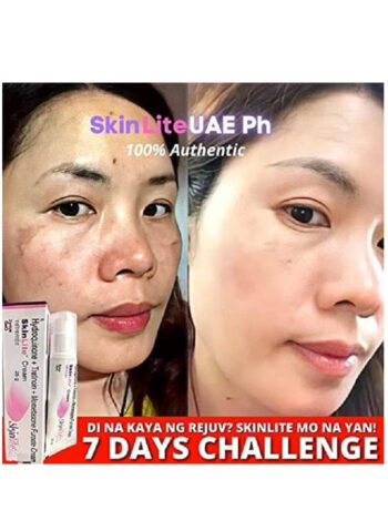 Skinlite Cream - Hydroquinone, Tretinoin and Mometasone Formula - Image 3
