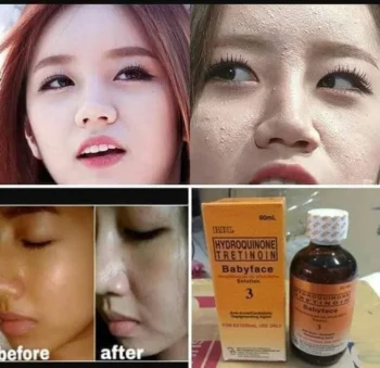 RDL Hydroquinone Tretinoin Babyface Solution Rx 3 – Anti-Acne & Depigmenting Agent - Image 3