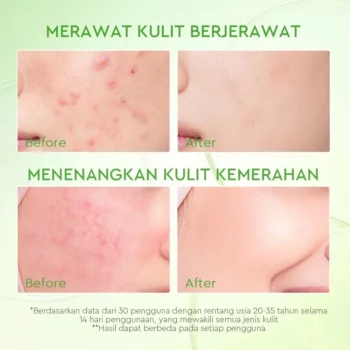 Glad2Glow KIWI 3D Acid Acne Moisturizer （30g）Acne Treatment Night Cream Face - Image 4